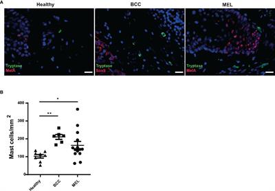 Human Melanoma-Associated Mast Cells Display a Distinct Transcriptional Signature Characterized by an Upregulation of the Complement Component 3 That Correlates With Poor Prognosis